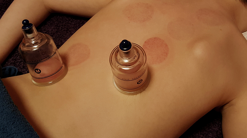 cupping-photo-1